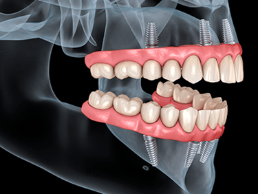 Implantodontia Odonto Medyc