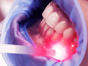 Laserterapia Focada Odonto Medyc