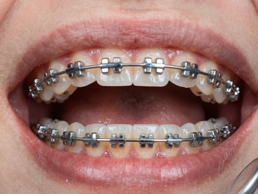 Close-up intraoral photograph of upper arch with ceramic brackets in place, tungsten clinical lighting revealing bracket bonding detail and archwire, documentary framing with dental mirror visible at edge