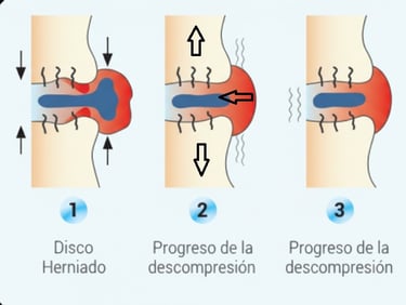 Proceso descompresión hernia