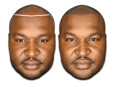 a before/after photo of a man who has received an SMP treatment on his scalp