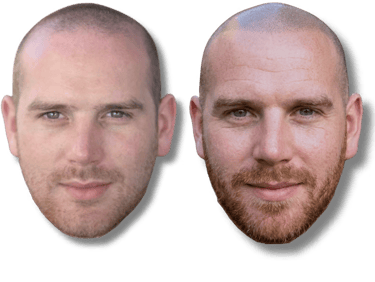 Before and after results of scalp micropigmentation for hair loss on a bald man with a beard.