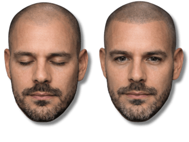 Before and after scalp micropigmentation results for male pattern baldness and hairline restoration.