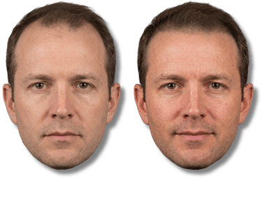 Before and after comparison of a man's scalp micropigmentation results for treating male baldness.