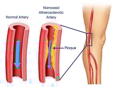 vascular ultrasound artery atherosclerosis stenosis disease stent bypass graft leg pain walking claudication peripheral block