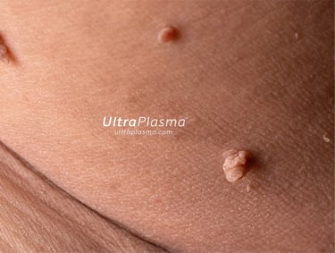 ultraplasma.com_wart_treatment_sigil_tedavisi_ultra_plasma_ultra_plazma_genital