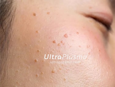 ultraplasma.com_wart_treatment_sigil_tedavisi_ultra_plasma_ultra_plazma_mouth_agiz