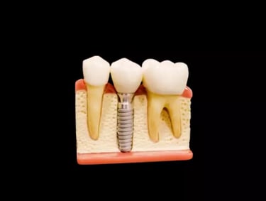 dental implants