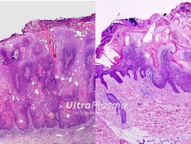 ultraplasma.com_seborrheik_keratosis_treatment_seboreik_keratoz_tedavisi_ultra_plasma_ultra_plazma
