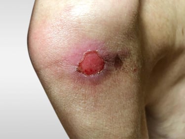 pressure ulcer