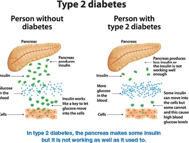 Type 2 diabetes