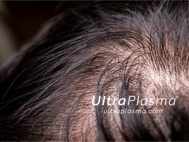 ultraplasma.com ultra plasma ultra plasma hair loss thin hair growth activation treatment