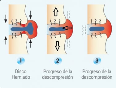 Proceso de reabsorción disco vertebral