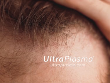 ultraplasma.com ultra plasma ultra plasma hair loss thin hair growth activation treatment