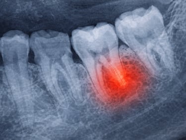 Emergency dentist in Greenville SC