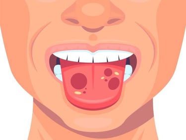 Stomatitis hygiene-precision.com