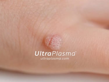 ultraplasma.com_wart_treatment_sigil_tedavisi_ultra_plasma_ultra_plazma_mouth_agiz