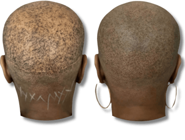 Before and after results of scalp micropigmentation for thinning hair and scar camouflage.