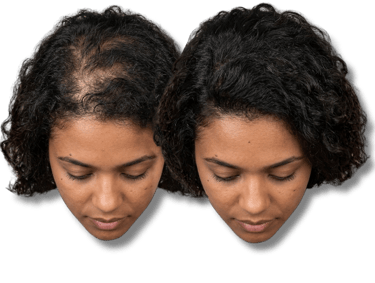Before and after comparison of a woman's scalp showing successful hair regrowth treatment for thinning hair.
