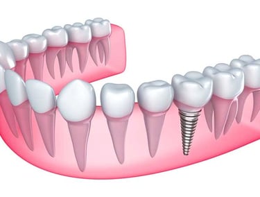 single tooth prosthetics