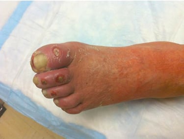 arterial ischemic ulcers