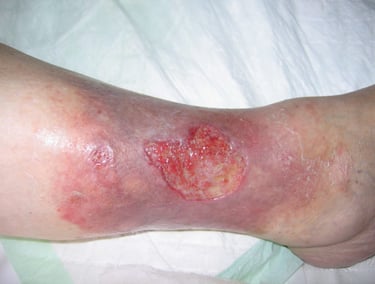 venous leg ulcer