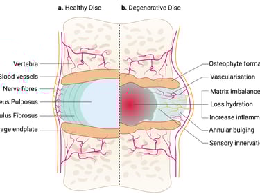 Envelhecimento da coluna vertebral esquematicamente