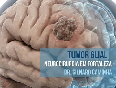 Medical illustration of a glial tumor on a human brain for neurosurgery in Fortaleza, Ceará.