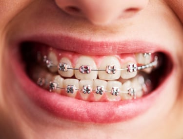 Boca con brackets sonriendo