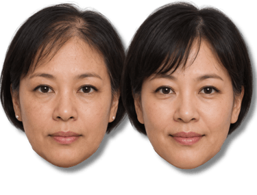 Before and after comparison of a woman's hair restoration treatment for female pattern baldness and thinning.
