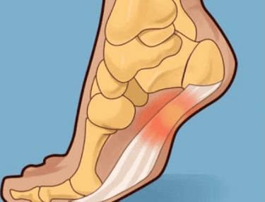 Tratamiento de Facitis Plantar
