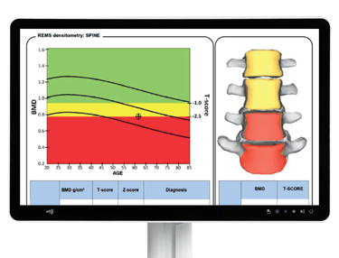 Echolight bone density report showing BMD, T-score, and spine assessment