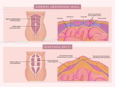 Diagram: Normal Abdominal Wall and Diastasis Recti