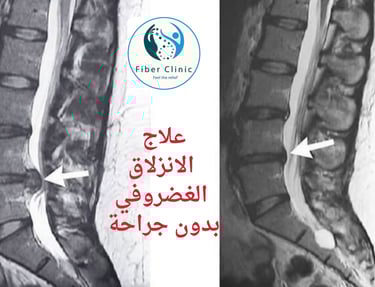 احدث طرق لعلاج الانزلاق الغضروفي بدون جراحة