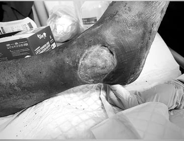 a person with a leg wound in a hospital bed