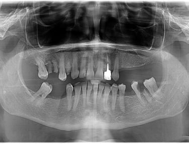 reabilitare orala implanturi