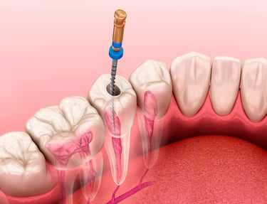 trattamento-endodontico-brescia
