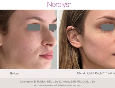 before and after skin rejuvenation treatment results in Hamilton clinic