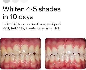 Teeth whitening in Greenville SC