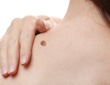 Mole and skin lesion expert assessment in Durham and Darlington at Ash Plastic surgery