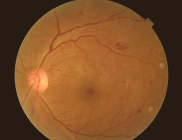 Retina. Diabetic Retinopathy.