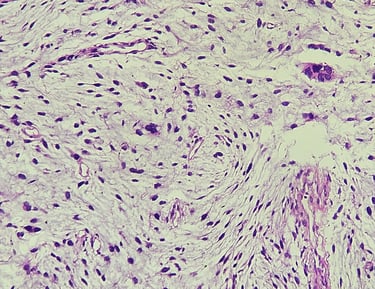 Sarcoma, Partes Moles, Tumores raros