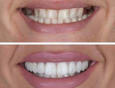 Before and after comparison of a smile makeover using porcelain dental veneers for whiter teeth.