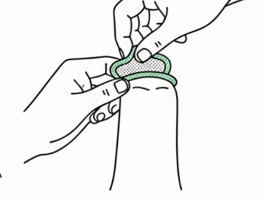 Hands putting condom on with foreskin