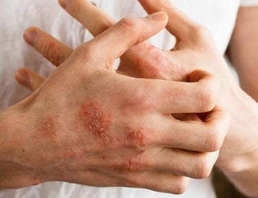 Close-up of a person scratching a red, scaly eczema skin rash on their hand and knuckles.