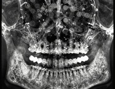 Two dental professionals perform a procedure on a patient. One is wearing specialized eyewear and is focused on using a dental instrument. The patient lies in a dental chair, wearing a protective bib.