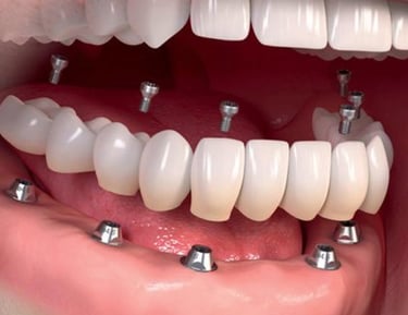 implantes dentales protesis sobre implantes