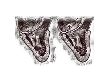 Mitral Valve Repair  Dr. Anbarasu Mohanraj