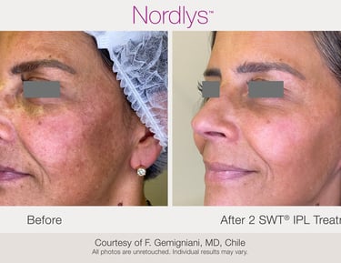 professional skincare consultation for acne and skin concerns in Hamilton clinic