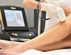 depilação a laser pele negra